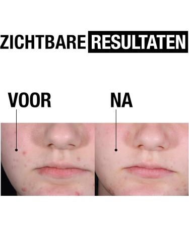 Kenvue Brands LLC Neutrogena Clear & Defend+ Peeling Serum Suitable for Sensitive Skin Types Dermatologically Tested Fragrance Free 30ml - Buy Online on GoSupps.com