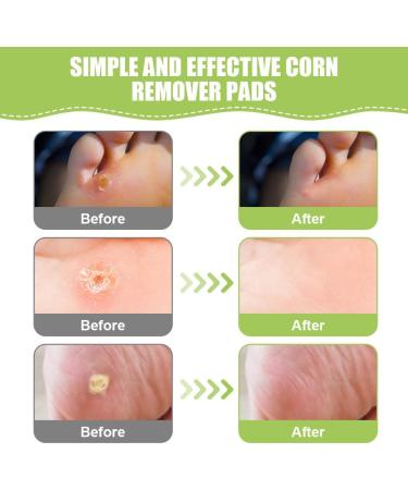 ACWOO Corn Remover Pads 24Pcs - Foot Corn & Wart Removal Patch for Pain Relief and Care - Buy Online on GoSupps.com