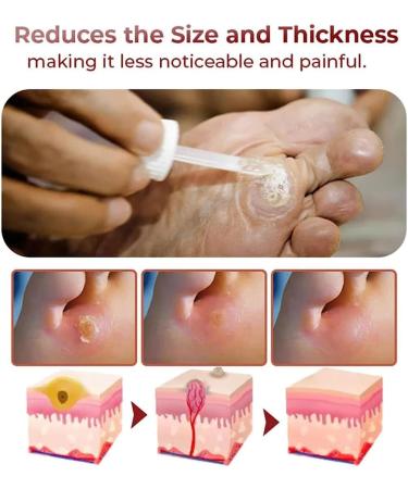 VERAMY Foot Corn Removal Extra Strength Gel - Quick Corn Remover Liquid (3PCS) - Buy Online on GoSupps.com