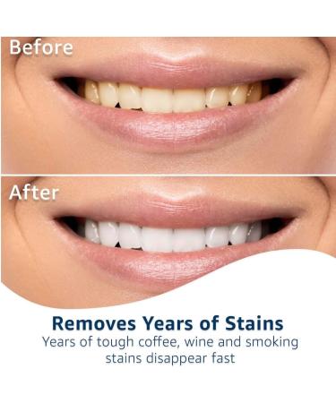 Equate Professional Teeth Whitening Strips - Enamel Safe 40 Strips (20 Treatments) | Buy Online for Whiter Teeth - Buy Online on GoSupps.com