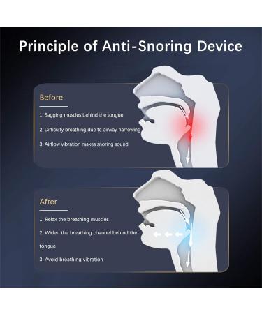 Smart Adjustable Anti-Snoring Device for Men and Women - Nasal Ventilation Snoring Solution for Better Sleep - Buy Online on GoSupps.com