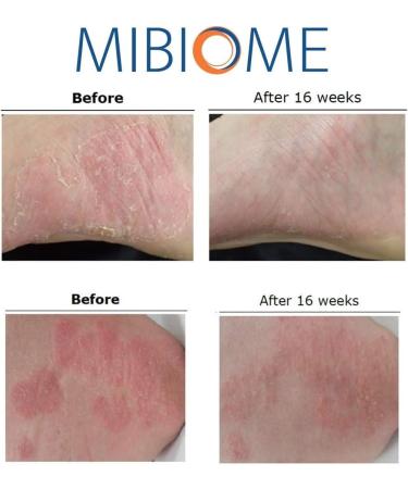 HNC Natural Psoriasis Relief & Fast Eczema Treatment | 50ml | Soothing Irritated & Scaling Skin - Compatible with MiBiome - Buy Online on GoSupps.com