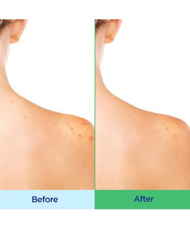 Differin Acne Body Wash - 10 oz Salicylic Acid Cleanser for Back, Chest, Shoulders - Buy Online on GoSupps.com