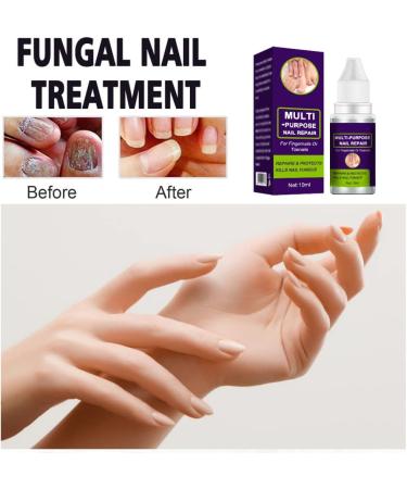 Nail Repair Toenail Care Solution Multi-purpose Renewl Restores Discolored and Damaged Nails 10 ML cracked nail repair gel - Buy Online on GoSupps.com
