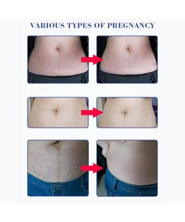 Dekaim 30ml Stretch Mark Essential Oil - Nourishing & Moisturizing Serum for Effective Stretch Mark Removal | Shop Internationally - Buy Online on GoSupps.com