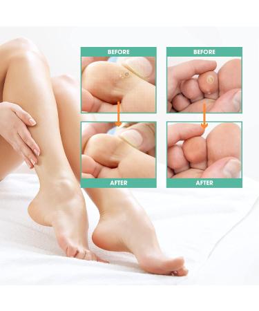 Wart Remover Pens - Natural & Safe Treatment for Foot & Hand Warts - Advanced Verruca, Corn, and Callus Removal - 2 Pens Per Box - Buy Online on GoSupps.com