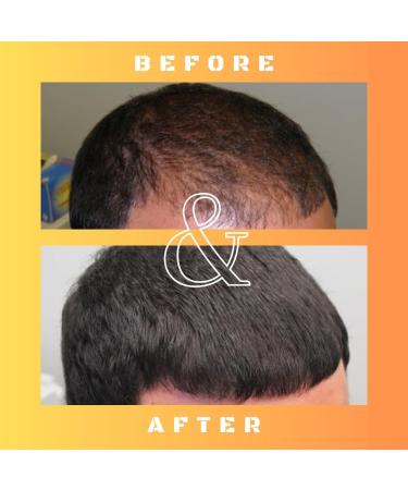 Mane Regain RU58841 5% Solution - DHT Blocker for Hair Loss - Promotes Regrowth & Prevents Baldness - 30ml - Buy Online on GoSupps.com