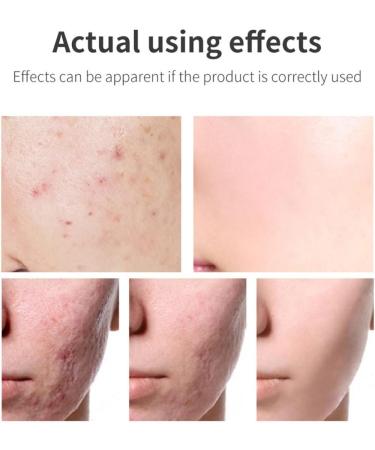 acne removal cream Acne Scar Removal Gel Face Body Marks Skin Repair Cream Acne Treatment Essence 30g - Buy Online on GoSupps.com
