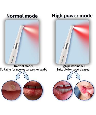 Truslite Infrared Red Light Therapy Device for Cold Sore & Fever Blister Treatment - Pain Relief & Healing for Lips, Mouth, Nose, Ear - Health Care - Black - Buy Online on GoSupps.com
