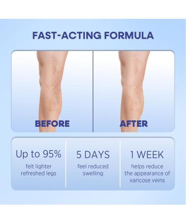 Hermon Varicose Veins Cream Varicose Veins for Legs Spider Vein for Legs Natural Soothing Leg Varicose & Spider Veins Cream - 5.07 Fl Oz (Pack of 1) - Buy Online on GoSupps.com