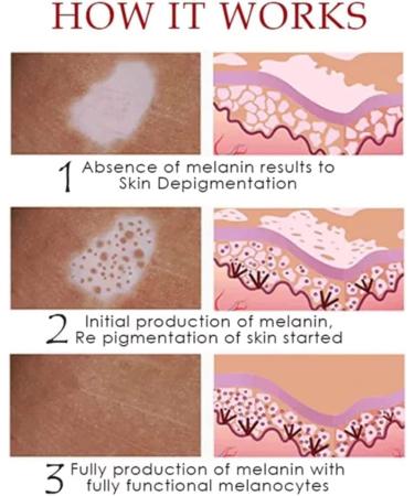 DUBUSH Vitiligo Removal Relief Spray - Skin Repair for Face and Body (3pcs) - Buy Online on GoSupps.com