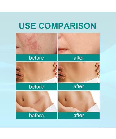 Medical Grade Scar Spray Effective Scar Removal for Surgical Scars & Stretch Marks | All Skin Types - Buy Online on GoSupps.com