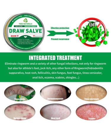 Tea Tree Oil Balm 1.76oz - Extra Strength Itch Relief Cream for Heat Rash, Tinea Versicolor, Butt Rash, Jock Itch & More - Non-irritating Formula for Men, Women, Kids, Adults - 50g - Buy Online on GoSupps.com