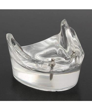 Gljy Dental Restoration Model - Overdenture Inferior 2 Implants Teaching Aid | Detachable Dental Teeth Model for Precision Demo | International Shipping Available - Buy Online on GoSupps.com