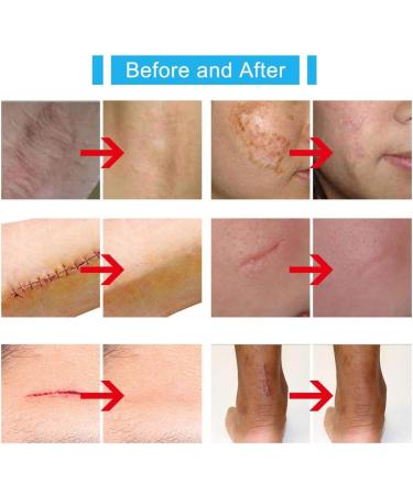 Kinbeau Silicone Scar Gel 30g - For Face, Body, C-Section, Stretch Marks, Surgical, Burn, Acne, Old & New Scars - White Blue - 1oz - Buy Online on GoSupps.com