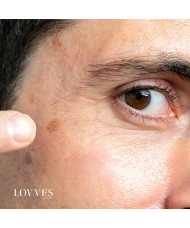 LOVVES Antiblemish facial serum Brightening High Natural Cosmetics Depigmenting Reduces Hyperchromia of the Skin Prevents the Formation of New Pimples Smoother Skin 30 ml - Buy Online on GoSupps.com