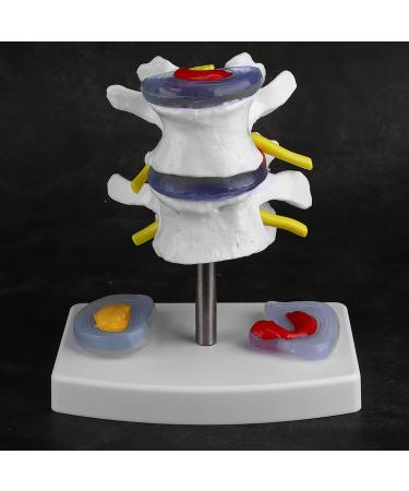 Anatomical Lumbar Intervertebral Disc Model - Spine Demonstration for Training & Education | International Shipping Available - Buy Online on GoSupps.com