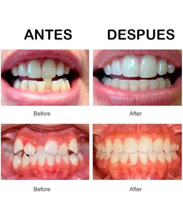 Protector Tooth Retainer for Smile Correction | 3-Stage Soft & Hard Dental Device | Professional Orthodontic Mouth Guard - Buy Online on GoSupps.com