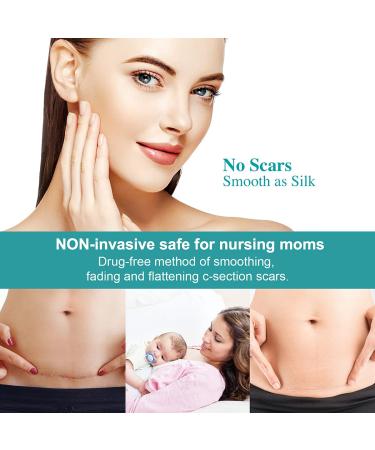 Krucasano Silicone Scar Removal Sheets - Softens & Flattens Old & New Scars - Ideal for C-Section, Burns, Acne & Stretch Marks - Skin-Colored - Buy Online on GoSupps.com