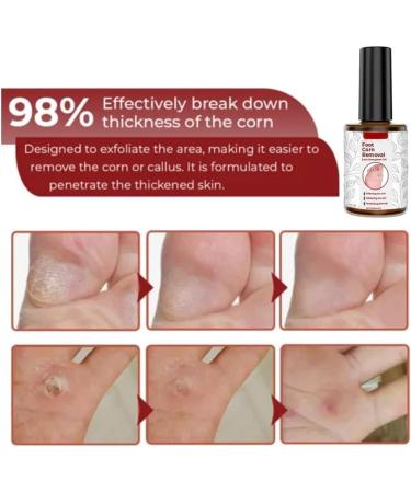 GFOUK Extra Strength Gel Corn Remover - Fast Acting Corn Removal for Feet, Toes, and Hands (4PCS) - Buy Online on GoSupps.com
