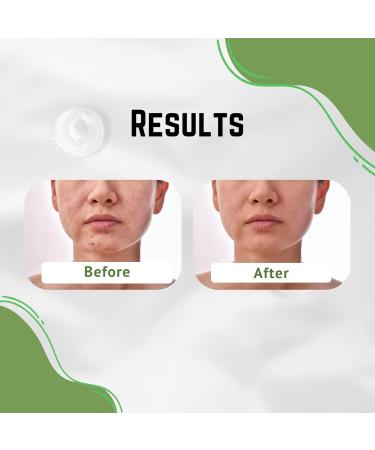 Aloe Vera Cream for Dark Spot Removal | Blemish Treatment & Scar Reducer | Face Cream for Men Women & Kids - Buy Online on GoSupps.com