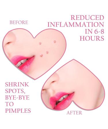 Mandabloom Acne Patches Pink Heart & Star Shaped Hydrocolloid Pimple Cover Patch with Tea Tree Oil - 104 Patches 14mm & 12mm - Buy Online on GoSupps.com