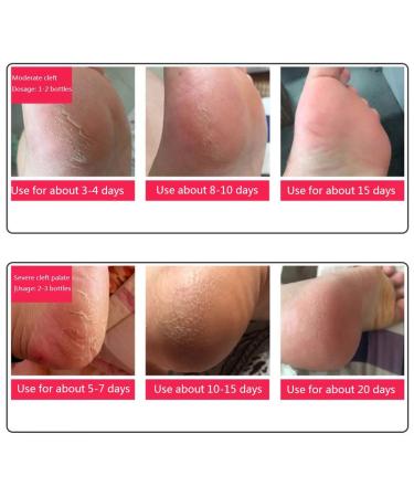 MRB Foot Care Cream - Repair Very Dry Feet & Cracked Heels | 55g Moisturizing Solution for Healthy Feet - Buy Online on GoSupps.com