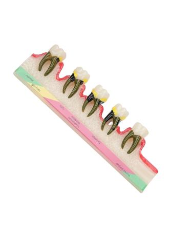 Dental Periodontal Disease Model Tooth Disease Study Teaching Model for Dental School - Buy Online on GoSupps.com