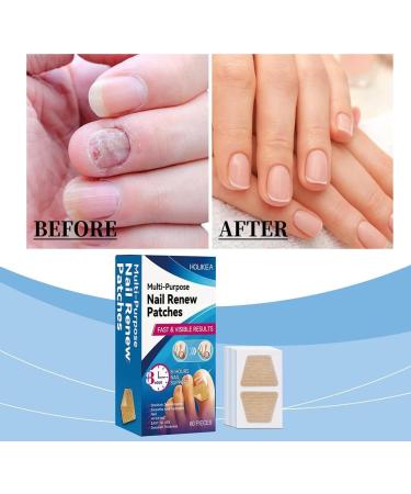 Lot de 60 patchs de r paration des ongles autocollants de correction des ongles anti-infection autocollants de soin des ongles en tissu non tiss pour le soin des ongles des orteils - Buy Online on GoSupps.com