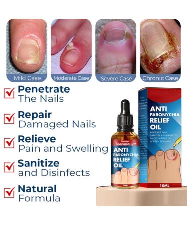 2PCS German Toenailplus Anti Paronychia Relief Oil - Nail Repair for Damaged Thick Nails - Buy Online on GoSupps.com