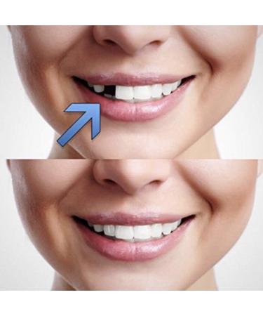 Buy Double Pack Quick Dental Tooth Temporary Dentures - Affordable Comfortable & Fast Shipping Worldwide - Buy Online on GoSupps.com