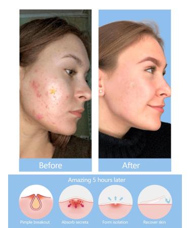 Star Pimple Patches - 316 Count Invisible Acne Treatment Cute Hydrocolloid Zit Covers with Centella Asiatica & Tea Tree Oil | International Shipping - Buy Online on GoSupps.com