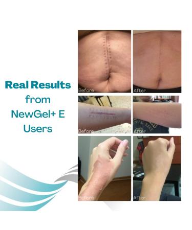 NewGel+E Advanced Silicone Scar Treatment Gel with Vitamin E - For Old and New Scars, Surgery, Injury, Keloids, Burns, and Acne Scars (1 oz) - Buy Online on GoSupps.com