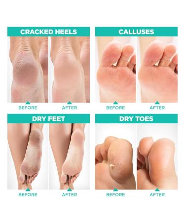 Lavinso Foot Peel Mask 2-Pack - Dead Skin Remover & Callus Treatment for Soft Baby Feet - Exfoliating Foot Mask with Aloe Vera Scent - Buy Online on GoSupps.com