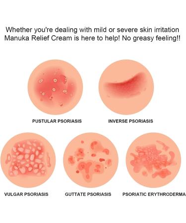 Manuka Honey Cream for Eczema Psoriasis Relief - Tinea Versicolor, Itchy Feet, Butt & Scalp - Bee Sting Bites Treatment - 4 Fl Oz Pack - Buy Online on GoSupps.com