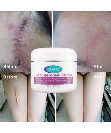 BeautyMALL Scar Removal Cream 50ml - Reduces Pimple Scars, Restores Skin to Original State - Softens and Smoothens Skin - Buy Online on GoSupps.com