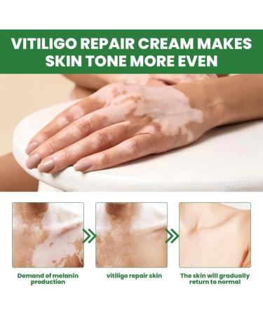 WXCOHB White Spot Repair Cream Repair Skin White Spot Melanin Cream Topical Care - Buy Online on GoSupps.com