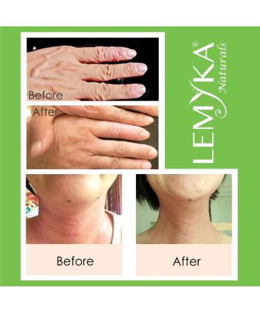 Natural Eczema Cream - Soothing Itch Relief for Atopic Dermatitis | Intensively Moisturizing & Anti-Itch Ointment with 10X Organic Aloe Vera | LEMYKA 2OZ - Buy Online on GoSupps.com