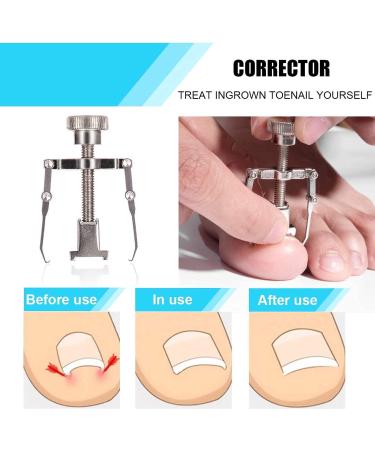 Ingrown Toenail Set - 5 Piece Professional Nail Tongs & Stainless Steel Manicure/Pedicure Kit by Oosofitt | Strong & Effective Care for Ingrown Toenails - Buy Online on GoSupps.com