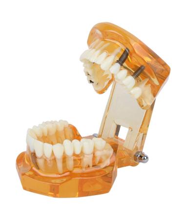 Standard Tooth Model - Removable Dental Teaching Materials for Kids & Adults | Typodont Demonstration Model - Buy Online on GoSupps.com