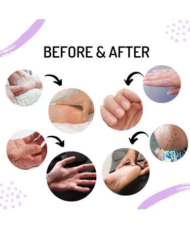 Urea Cream 40% for Cracked Skin Repair | Best Callus Feet Lotion | Intensive Foot Care Treatment | Hydrating Hand & Foot Moisturizer - Buy Online on GoSupps.com