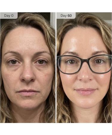 SHINING FACE Micro Infusion Skincare System - 0.25mm Facial Stamp with Collagen Peptide & Hyaluronic Acid Serum At Home Glow- 3 Month Supply - Buy Online on GoSupps.com