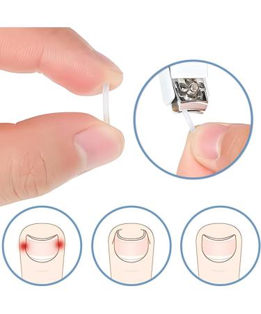 50 Pieces Ingrown Nails Feet Strips Corrector for Ingrown Nails Ingrown Toenails Ingrown Nails Ingrown Nails Feet Pedicure Tools for Foot Care for Men and Women - Buy Online on GoSupps.com