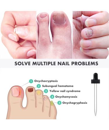 2PCS Kerassentials Toenail Treatment - Extra Strength Formula for Repairing Damaged Nails (30ml) - Buy Online on GoSupps.com
