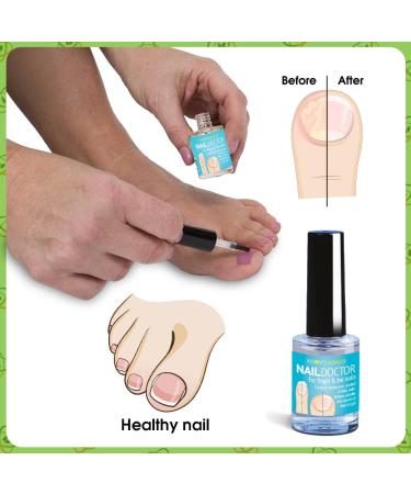 VYTALIVING BioClear Nail Doctor - Ingrown Toenail Treatment - Fungal Nail Treatment for Toenail Aids in Toe Nail Care | 15 ml - Buy Online on GoSupps.com