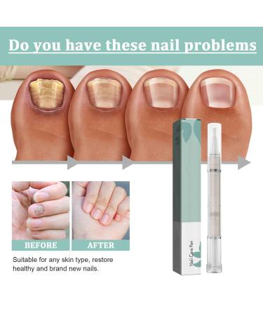 Nail Care Pen for Fungus - Aloe Vera Tea Tree Oil & Vitamin E | Nourish Fingernails & Toenails | International Shipping - Buy Online on GoSupps.com