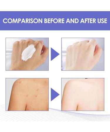Crema Blanqueadora para Partes Intimas Aclarador de Axilas y Partes Intimas Blanqueador de Axilas y Partes Intimas Crema para Aclarar Las Axilas y Partes Intimas - 30ML/1.0 FL.Oz (1 PCS) - Buy Online on GoSupps.com