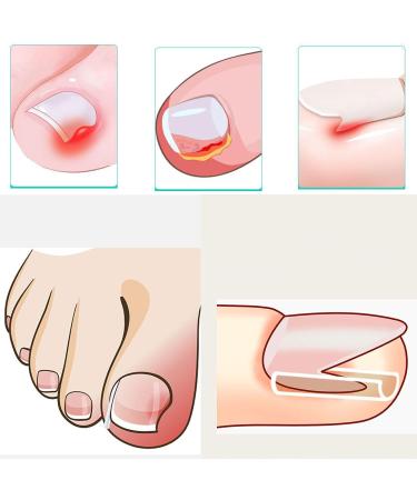 Ingrown Toenail Clipper Set for Thick or Ingrown Nails - 52pcs Stainless Steel Grooming Tools - Buy Online on GoSupps.com