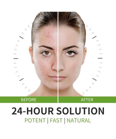 Jesswar Acne Treatment Face Cream - Cystic Acne Spot Treatment for All Skin Types (0.21 Oz) | Fast International Shipping - Buy Online on GoSupps.com