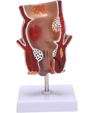 Anatomy Model: Human Rectal Lesion Fistula & Fissure Pathology - Ideal for Teaching | International Shipping - Buy Online on GoSupps.com